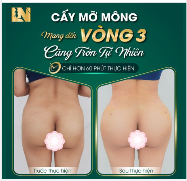 CẤY MỠ MÔNG MANG ĐẾN VÒNG 3 CĂNG TRÒN TỰ NHIÊN