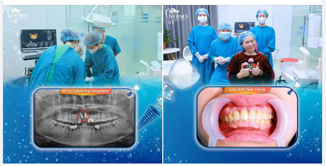 TÁI TẠO NỤ CƯỜI MỚI NHỜ TRỒNG RĂNG IMPLANT