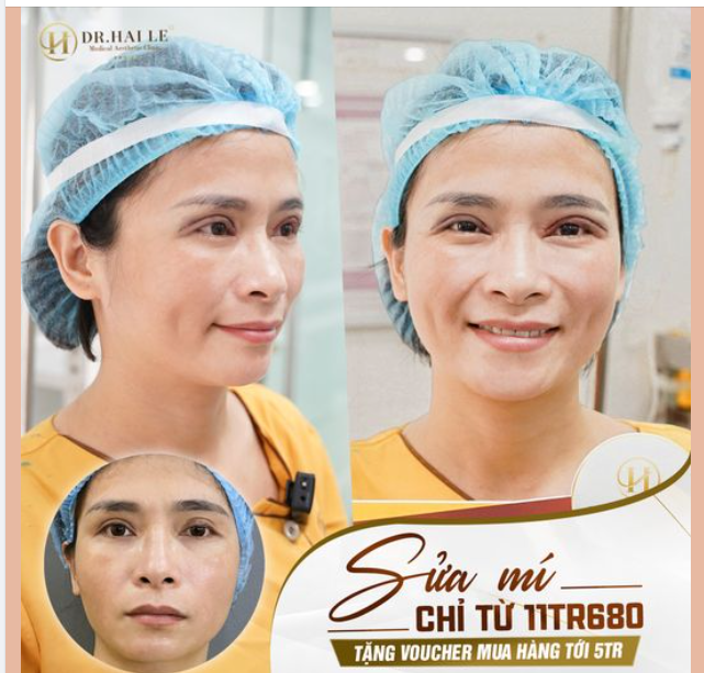 Sửa mí Dr hải Lê - Cứu tinh cho khách hàng có cặp mí lỗi hỏng