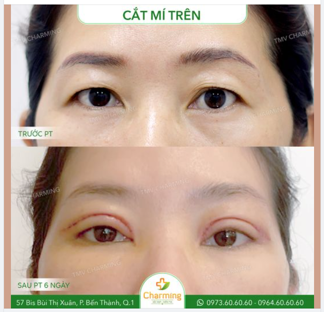 Mắt to, vốn dĩ là mắt hai mí nhưng da mí phát triển mạnh mẽ khiến mắt bạn trông như thể một mí. Với những trường hợp thế này thì... cắt mí thôi