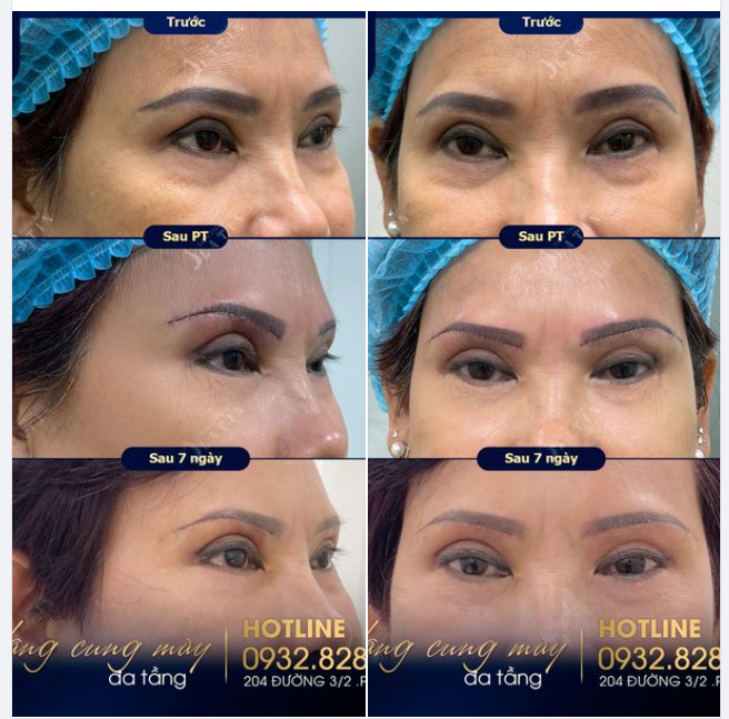 Trẻ hóa đôi mắt cho cô khách trung niên với dịch vụ nâng cung mày đa tầng