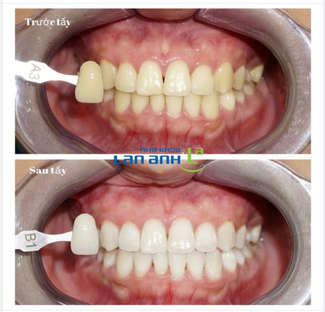Tẩy trắng răng tại nhà hay tại nha khoa sẽ đạt hiệu quả cao hơn?