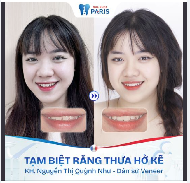 HÔ BIẾN NỤ CƯỜI THAY ĐỔI SAU DÁN VENEER