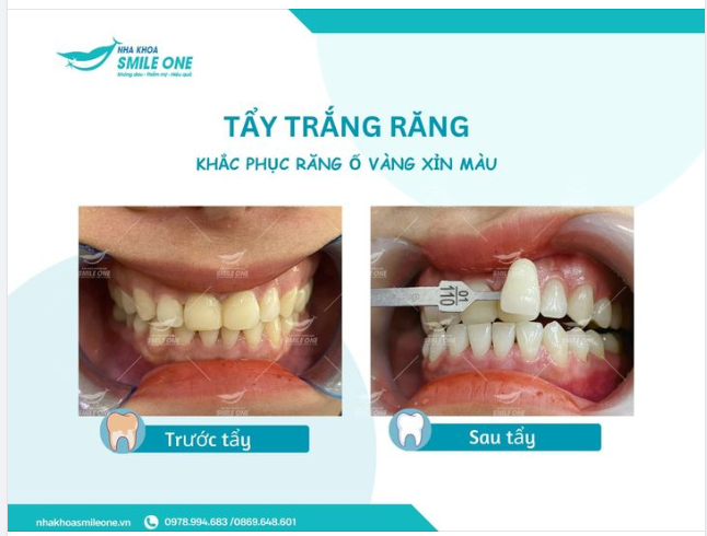Tẩy trắng răng khắc phục răng ố vàng, xỉn màu!