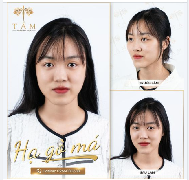 Tiêm hạ gò má được biết đến là phương pháp giúp gương mặt cân đối khắc phục được tình trạng gò má cao.