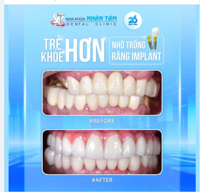 Trẻ hơn, khoẻ hơn nhờ trồng răng Implant