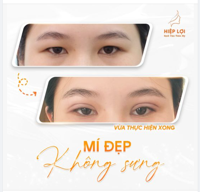 Ca mí "siêu nét" sau 45 phút khách hàng thực hiện tại Hiệp Lợi