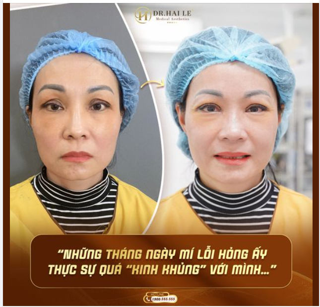 "Nếu không có Dr.Hải Lê giúp mình “giải cứu” cặp mí lỗi hỏng thì chẳng biết giờ này mình có còn ngồi để viết những dòng này hay không.
