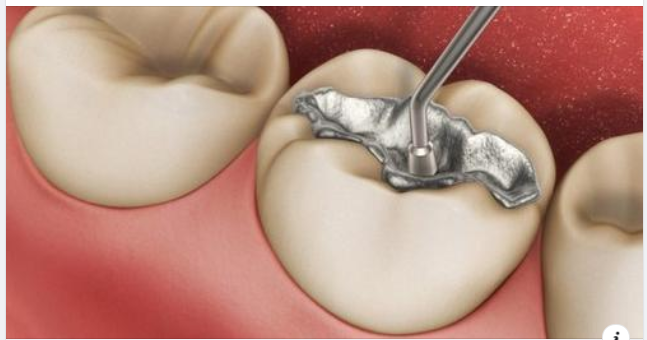 Cách chăm sóc răng sau hàn trám điều trị sâu