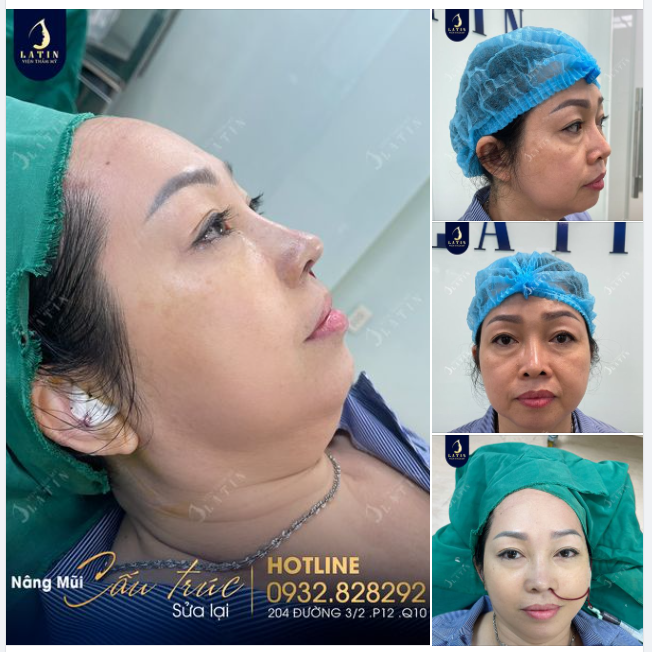 Mũi sửa lại, chỉnh khuyết cánh cho chị gái đến từ Vũng Tàu