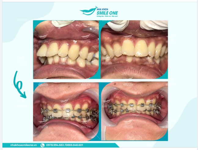 Sự kỳ diệu của niềng răng mắc cài!