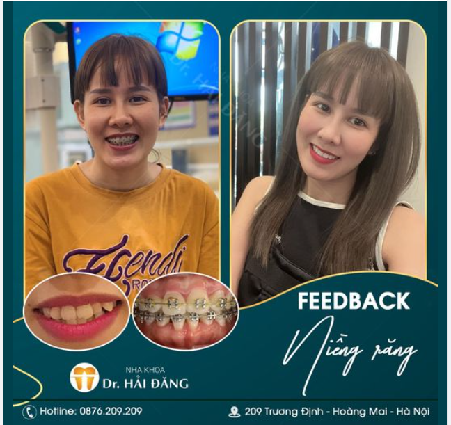 Niềng răng- Hành trình lột xác nụ cười của tôi