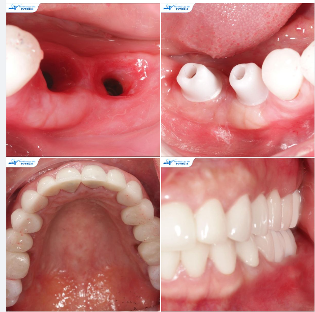 CÔNG NGHỆ DCT MANG LẠI CHIẾC RĂNG IMPLANT TIỆM CẬN SỰ HOÀN HẢO