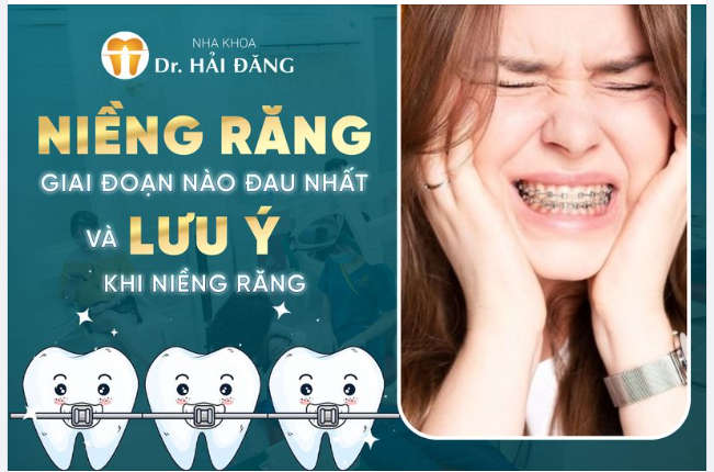 Có nhiều bạn đến niềng răng và thường hay hỏi bác sĩ rằng:  Niềng răng giai đoạn nào là đau nhất và điều gì cần lưu ý không bác sĩ