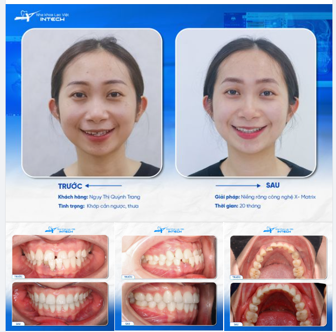 CÔ GÁI RĂNG MÓM HỒI SINH LẠI NỤ CƯỜI SAU GẦN MỘT THẬP KỶ