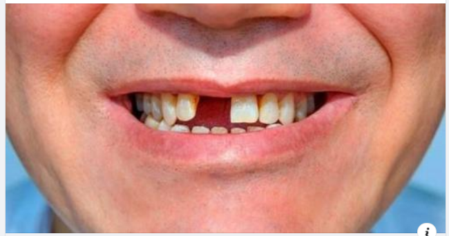 Không trồng răng giả sau khi nhổ răng có sao không?