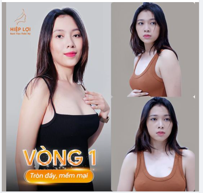 Flex ca ngực "cực xịn" của chị khách hàng tại Hiệp Lợi