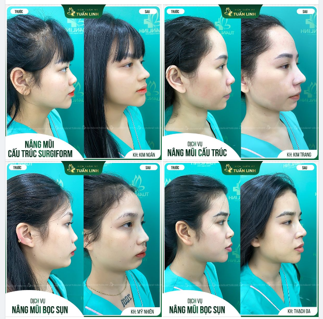 Mũi vừa phẫu thuật không sưng đau, đẹp chuẩn dáng!!
