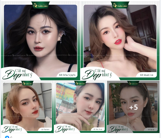 Cắt mí Plasma say bye mắt một mí - Tái sinh đôi mắt đẹp.