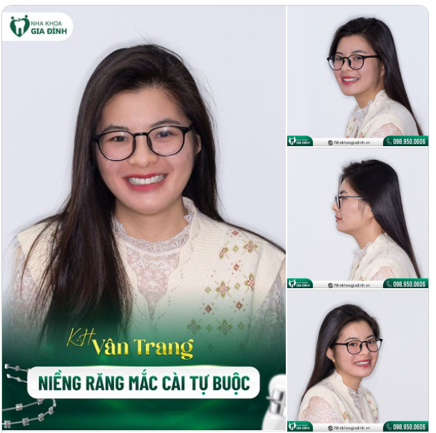 RĂNG ĐỀU HƠN, TỰ TIN HƠN VỚI NIỀNG RĂNG CHỈNH NHA TẠI NHA KHOA GIA ĐÌNH