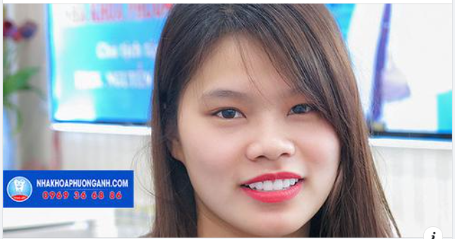 Bọc răng sứ thẩm mỹ thay đổi nụ cười