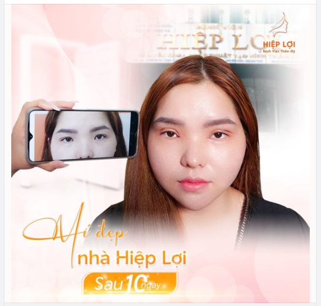 MÍ ĐẸP TỰ NHIÊN - SAU 10 NGÀY