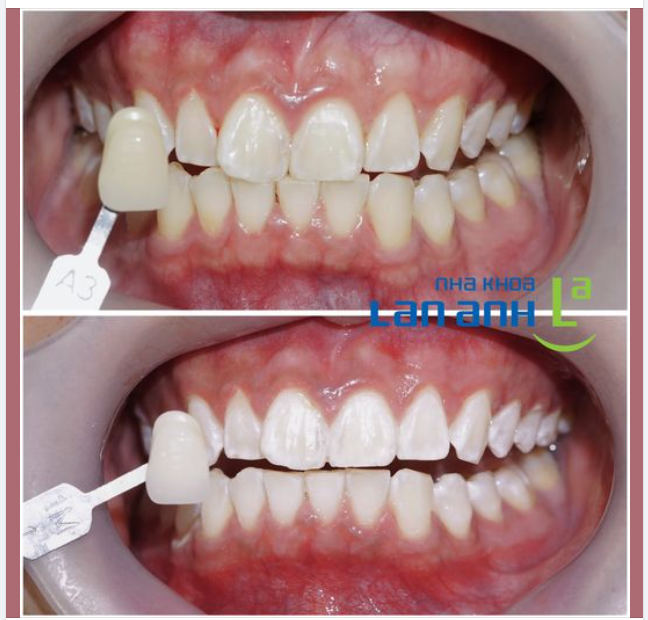 Bí mật răng trắng sáng - Khám Phá Phương Pháp Tẩy Trắng Răng
