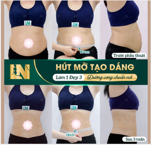 Thay đổi ngoạn mục chỉ sau 3 tuần với hút mỡ tạo dáng!