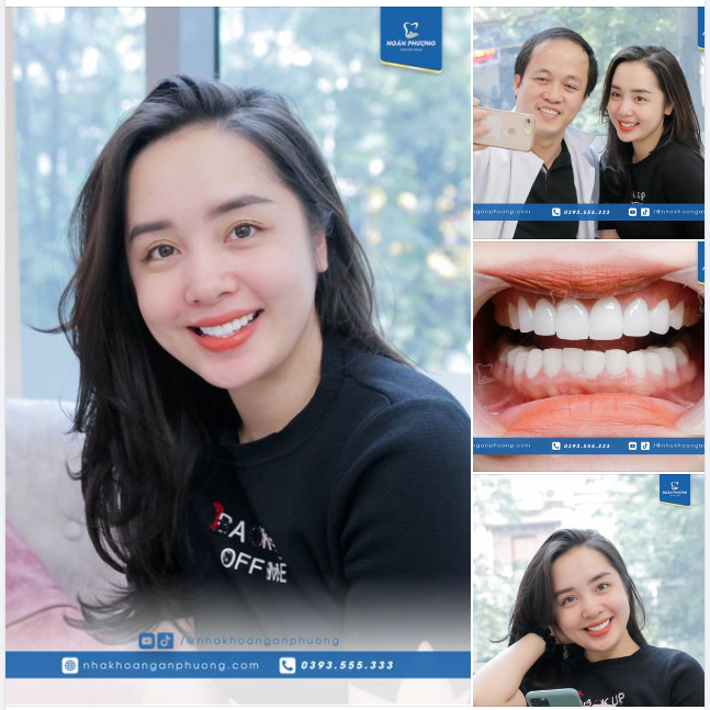 Nụ cười của Huệ Lâm vẫn xinh đẹp như ngày đầu làm răng sứ