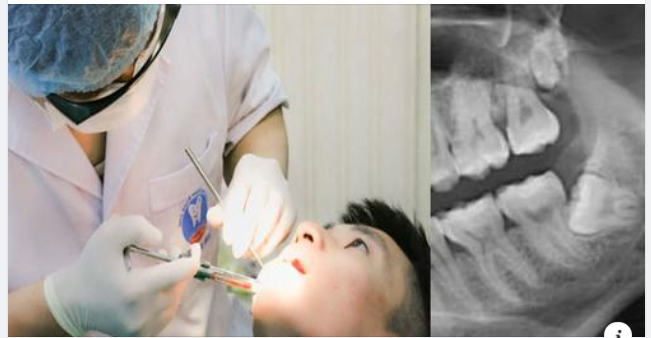 Hướng dẫn chăm sóc sau khi nhổ răng khôn
