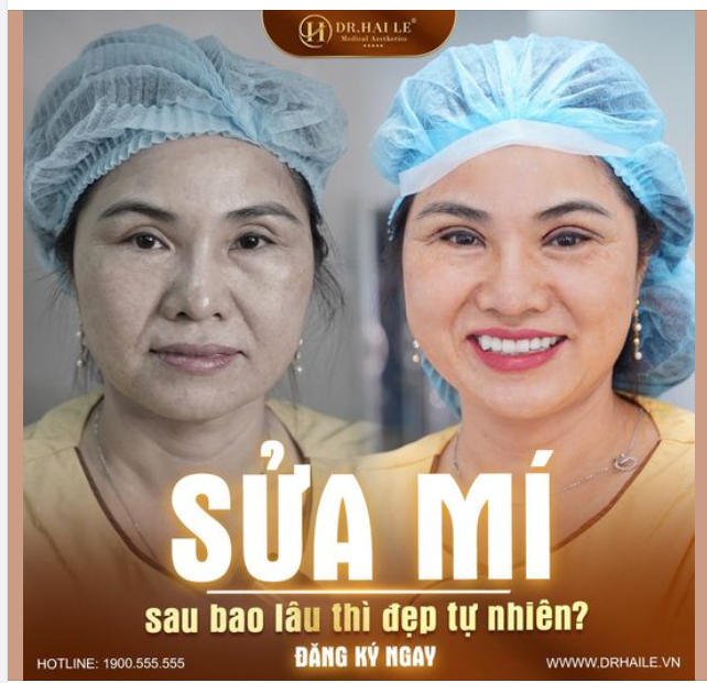 Thông thường quá trình hồi phục sau khi sửa mí mắt sẽ được chia thành các giai đoạn như sau: