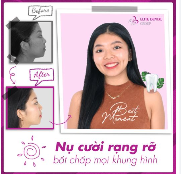 HOÀN THIỆN VẺ ĐẸP NỤ CƯỜI NHỜ NIỀNG RĂNG CÙNG TIKTOKER BẢO CHÂU