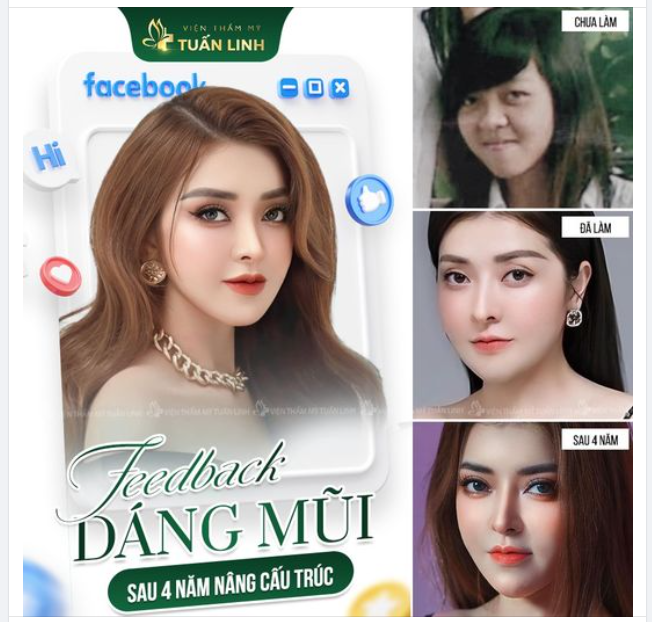 Bạn sẽ không biết mình có thể thay đổi như thế nào cho đến khi bạn nâng mũi!!