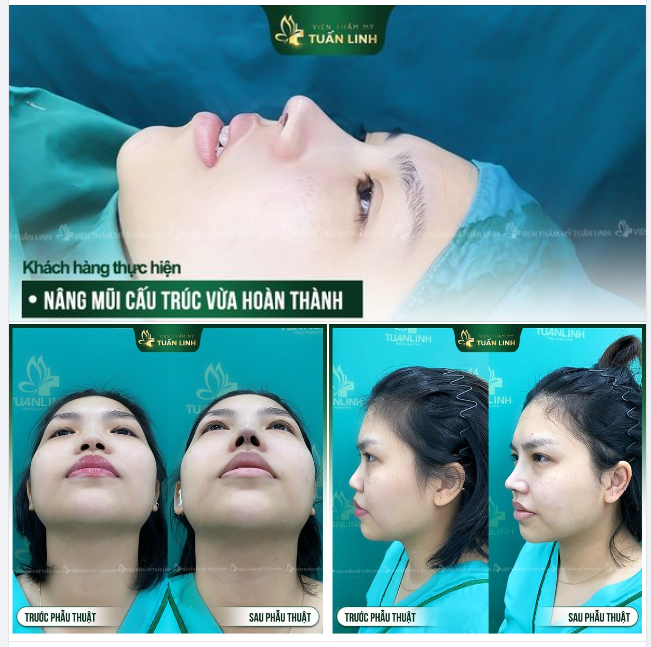 THÁNG CỦA NÀNG - NÂNG MŨI CAO SANG - CHI PHÍ NHẸ NHÀNG!!