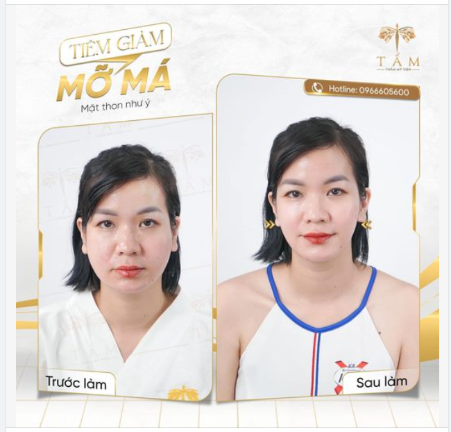 XÓA TAN NỖI LO MẶT BÉO NHỜ CÓ "TIÊM GIẢM MỠ MÁ" TẠI TẤM