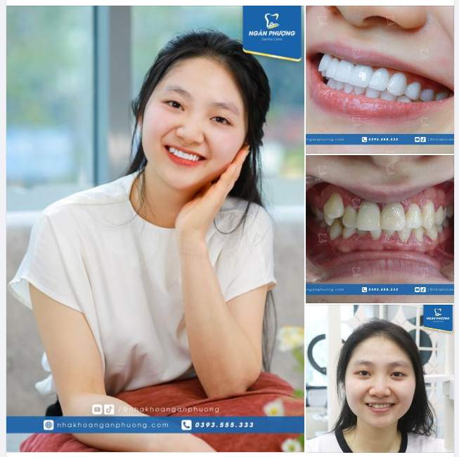 Làm sứ có giữ được răng khểnh không?