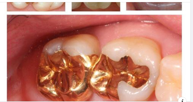 Chọn chất liệu trám phù hợp cho răng của bạn như thế nào