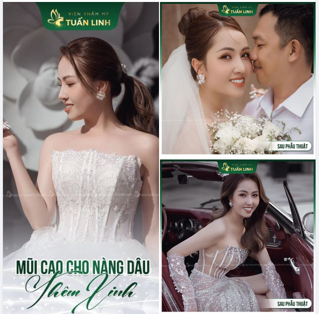 Chọn nâng mũi để xinh sang trong mọi khoảnh khắc!!