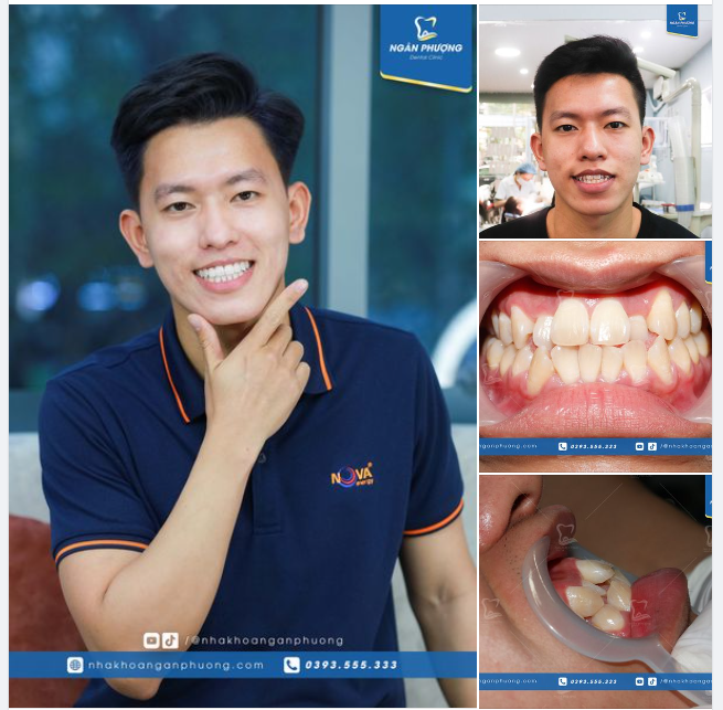 Chàng trai triệu view với màn thay đổi ngoạn mục chỉ nhờ niềng răng