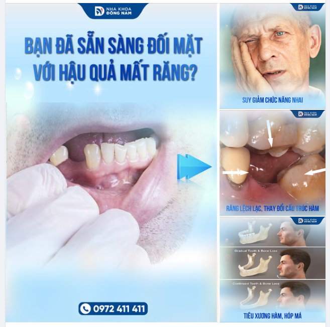 KHI NHỔ 1 CHIẾC RĂNG HÃY CHUẨN BỊ LUÔN CẢ VIỆC TRỒNG LẠI RĂNG GIẢ