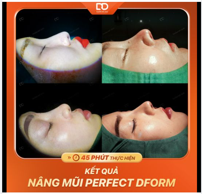 NHỮNG CHIẾC MŨI XINH VỪA THỰC HIỆN.