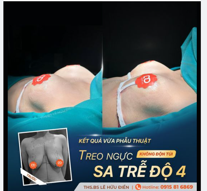 TREO SA TRỄ KHÔNG ĐẶT TÚI - NGỰC VẪN TRÒN CĂNG