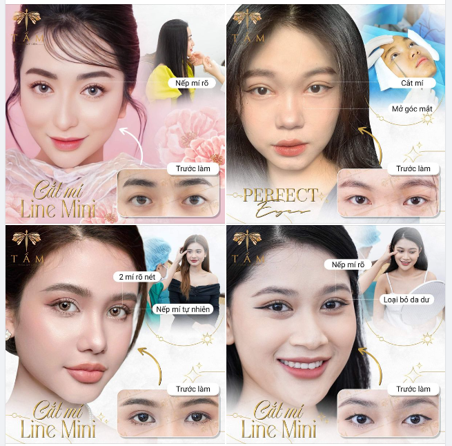 Cắt mí - một trong những dịch vụ hot nhất tại Thẩm Mỹ Viện Tấm.