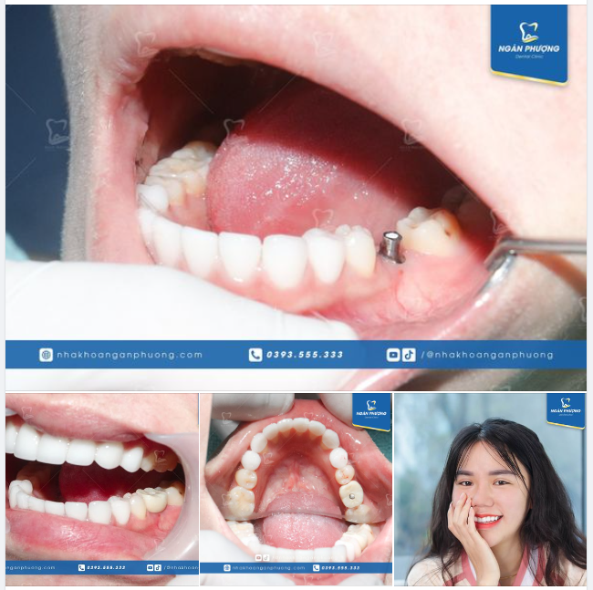 Tại sao răng 6 là răng hàm nhanh hỏng nhất?