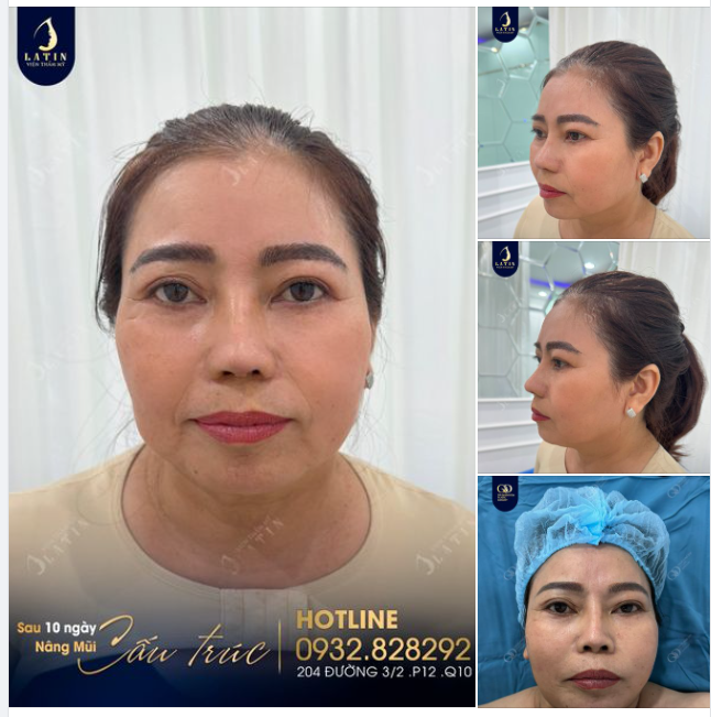 Kết quả sửa mũi sau 10 ngày cho chị khách hàng đến từ Tây Ninh.