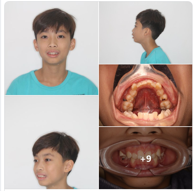 CAN THIỆP CHỈNH NHA SỚM, SỚM LẤY LẠI SỰ TỰ TIN CHO TRẺ