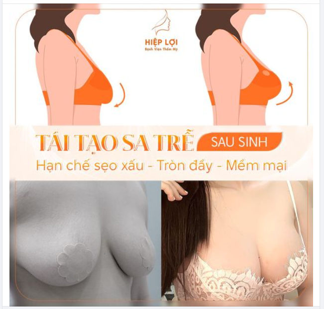 Phương pháp TÁI TẠO SA TRỄ sau sinh "mới nhất" tại Hiệp Lợi 