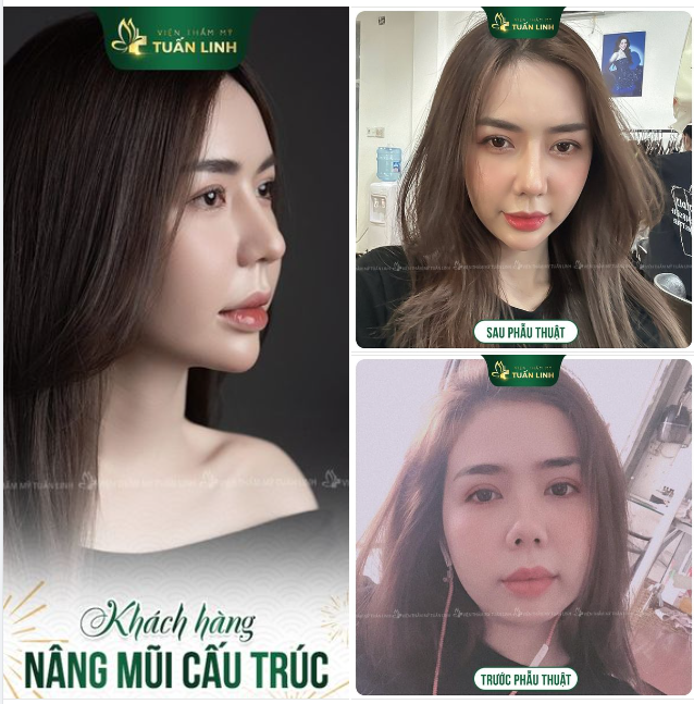 Tự tin tỏa sáng với dáng mũi xinh!!