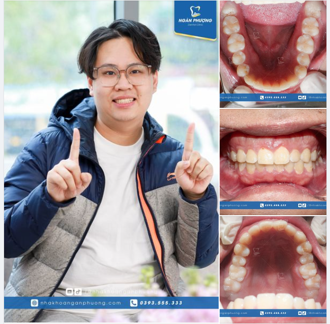 Bầu trời uy tín! Khách tháo niềng 10 năm quay lại tái khám, ca này mấy ai làm lại Ngân Phượng nhé!