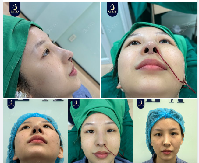 Mũi sửa lại kết quả viên mãn cho em gái. Mũi cấu trúc sửa lại bọc sụn tai, sử dụng sóng surgiform.